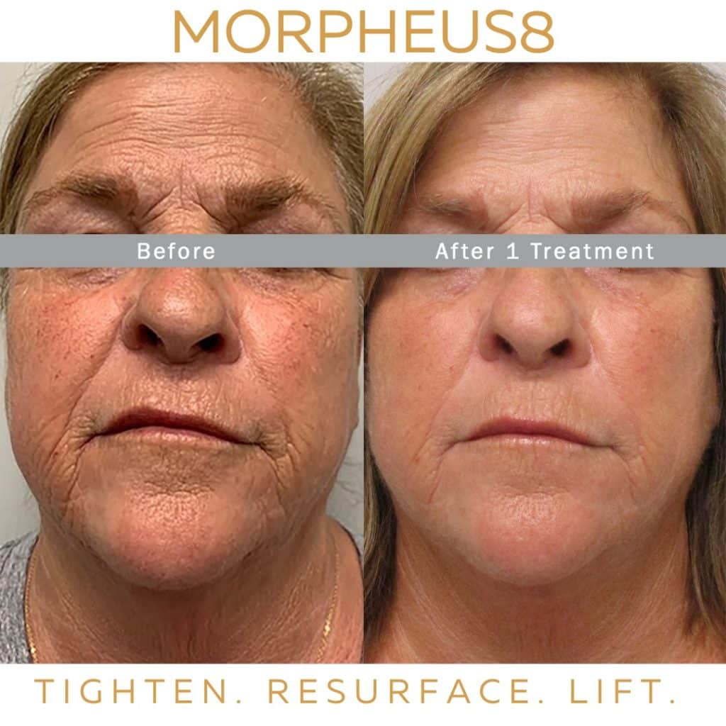 Morpheus8 | Derma Secret