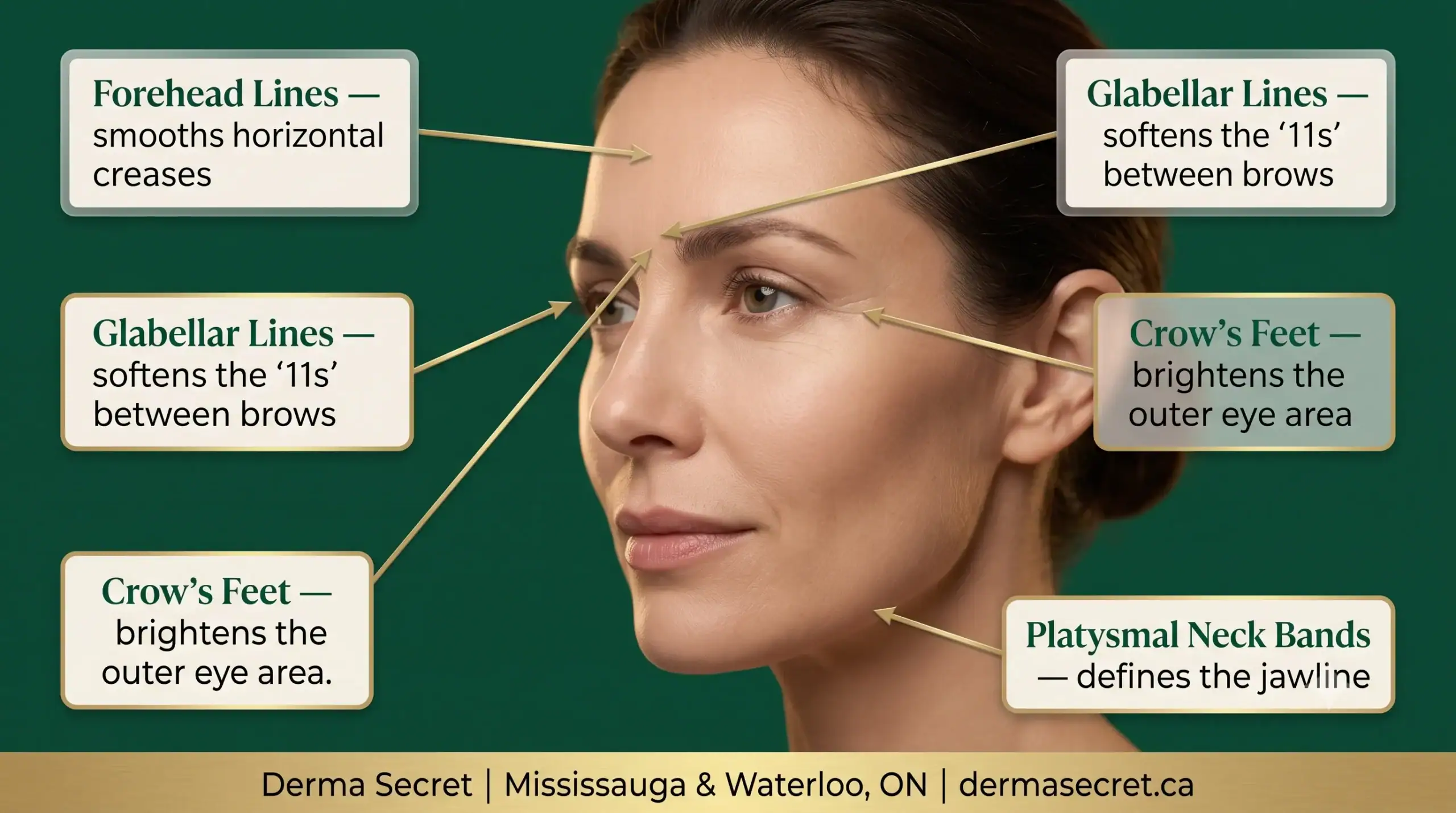 Facial treatment map showing common Botox uses for forehead, glabella, crow's feet, and neck at Derma Secret Waterloo