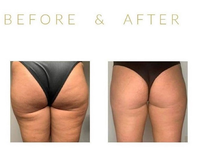 Bothered By Cellulite? 4 Cellulite Reduction Treatments That Work