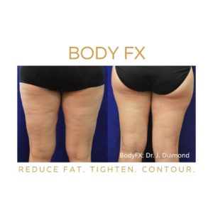 BodyFX Treatment