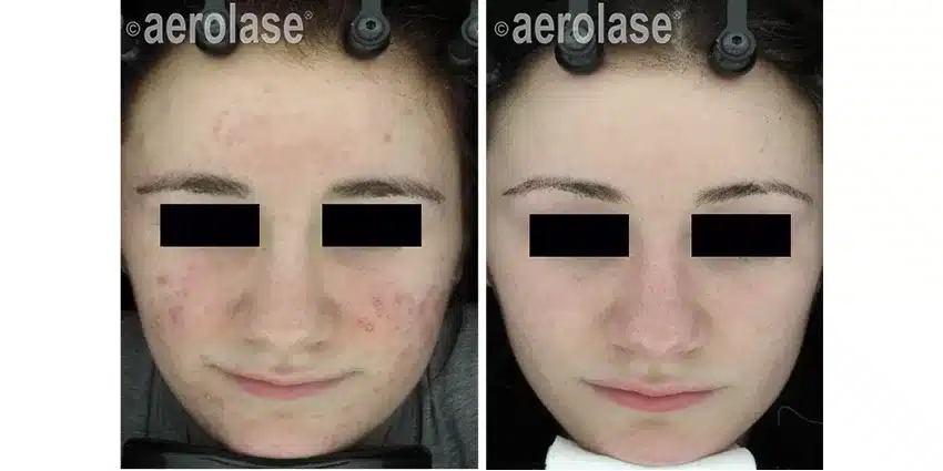 NeoClear-Acne-3-Months-After-5-Treatments-David-Goldberg-MD