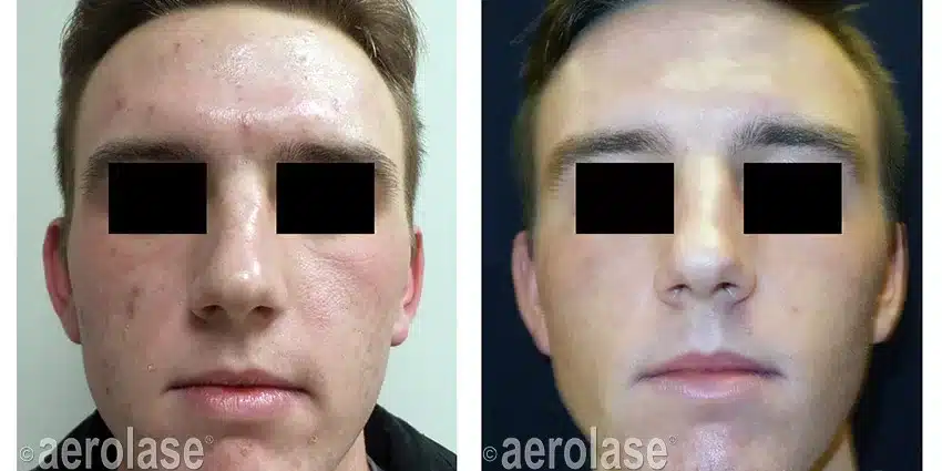 NeoClear-Acne-After-3-Treatments-Kevin-Pinski-MD