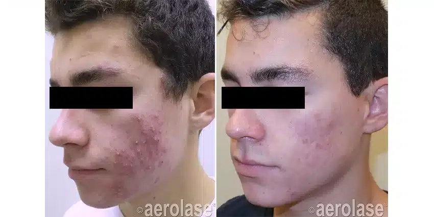 NeoClear-Acne-After-4-Treatments-Kevin-Pinski-MD