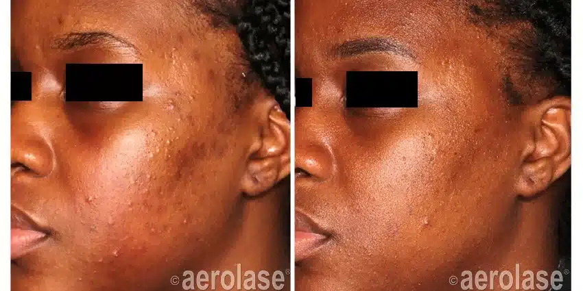 NeoClear-Acne-After-4-Treatments-Michelle-Henry-MD