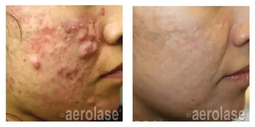 NeoClear-Acne-After-5-Treatments-Michael-Gold-MD