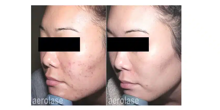 NeoClear-Acne-After-6-Treatments-Spade-Skin-Care