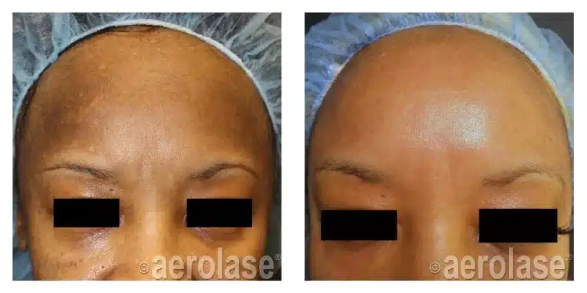 NeoSkin-Melasma-After-1-Treatment-combined-with-Glycolic-Peel-Cheryl-Burgess-MD