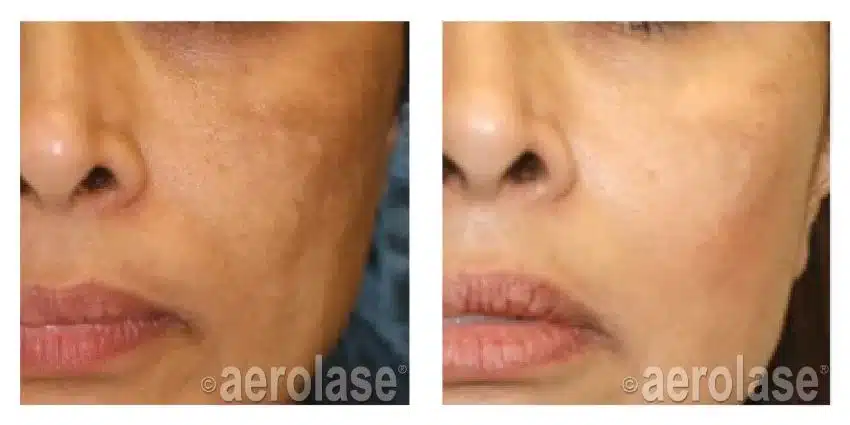 NeoSkin-Melasma-After-1-Treatment-combined-with-Hydroquinone-Cheryl-Burgess-MD
