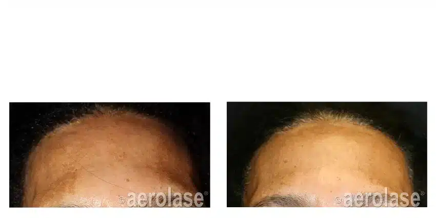 NeoSkin-Melasma-After-1-Treatment-combined-with-TCA-Peel-Cheryl-Burgess-MD