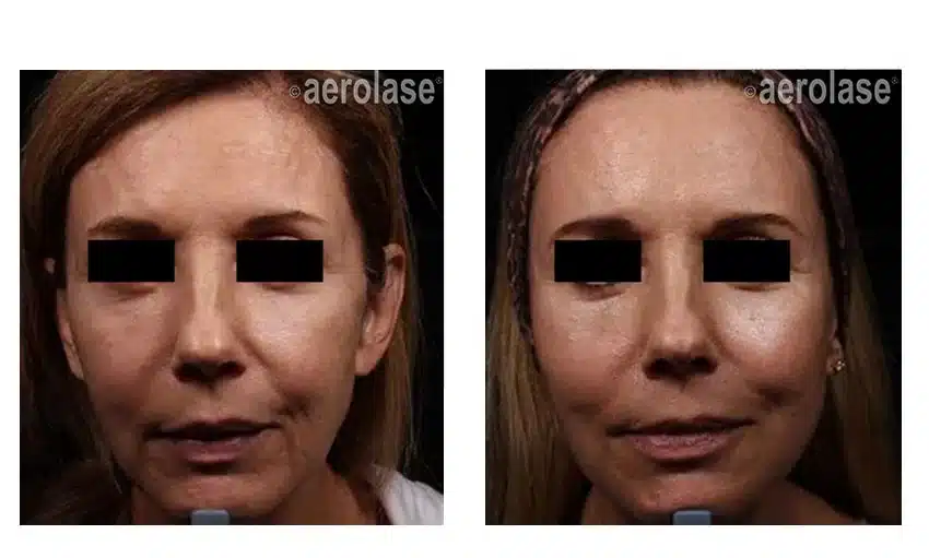 NeoSkin-Rejuvenation-After-2-Treatments-combined-with-threads-and-filler-One-Aesthetics-2