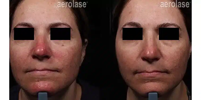NeoSkin-Rosacea-1-Week-After-1-Treatment-One-Aesthetics