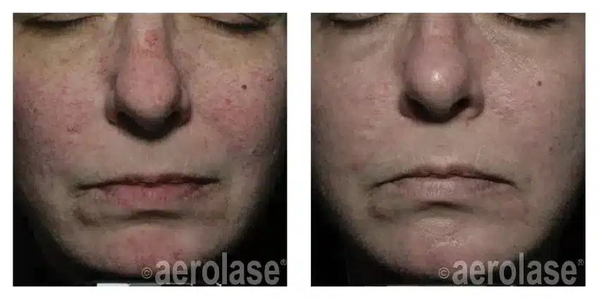 NeoSkin-Rosacea-and-Veins-After-2-Treatments-David-Goldberg-MD
